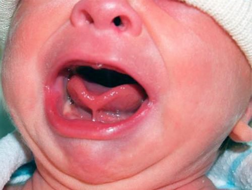 Khi trẻ khóc, đầu lưỡi trẻ hình trái tim do lưỡi bị giới hạn cử động