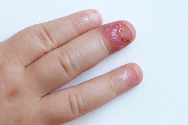 Khi trẻ bị mưng mủ ở ngón tay, trẻ thường biếng ăn, quấy khóc.