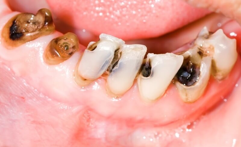 vệ sinh răng miệng kém khiến răng trẻ bị đen