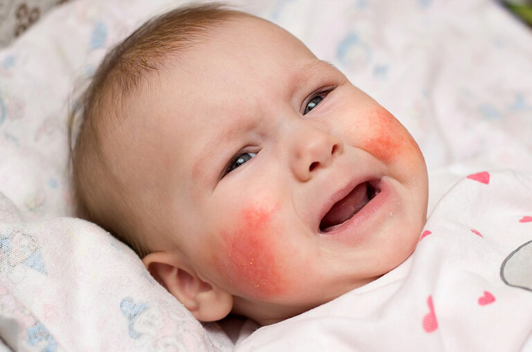 chàm sữa khiến bé ngứa ngáy khó chịu