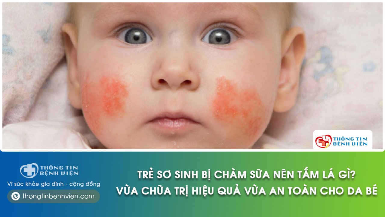 trẻ sơ sinh bị chàm sữa