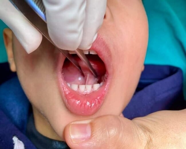 Phẫu thuật cho trẻ bị dính thắng lưỡi
