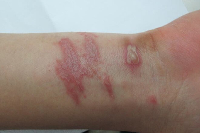 vết đốt của kiến ba khoang