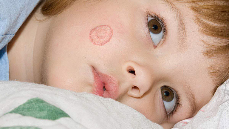 Lác đồng tiền ở trẻ sơ sinh do những mẫu vi nấm da dẫn đến.