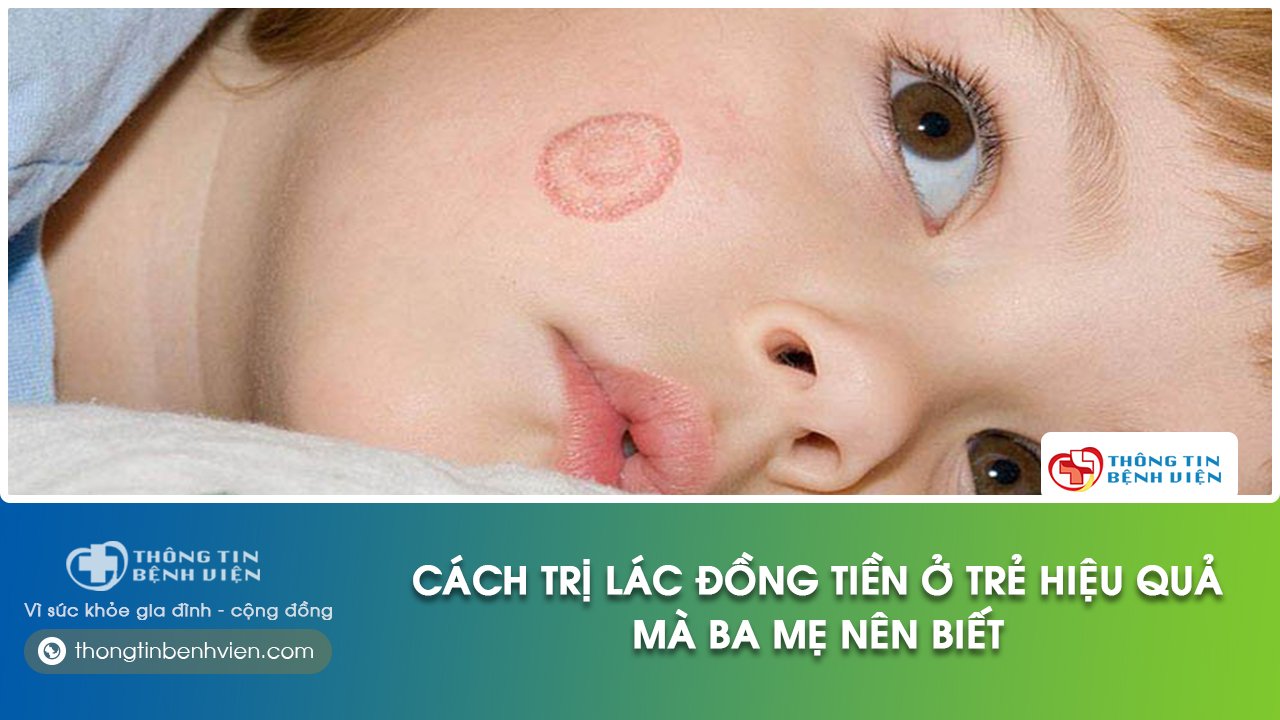 trẻ bị lác đồng tiền