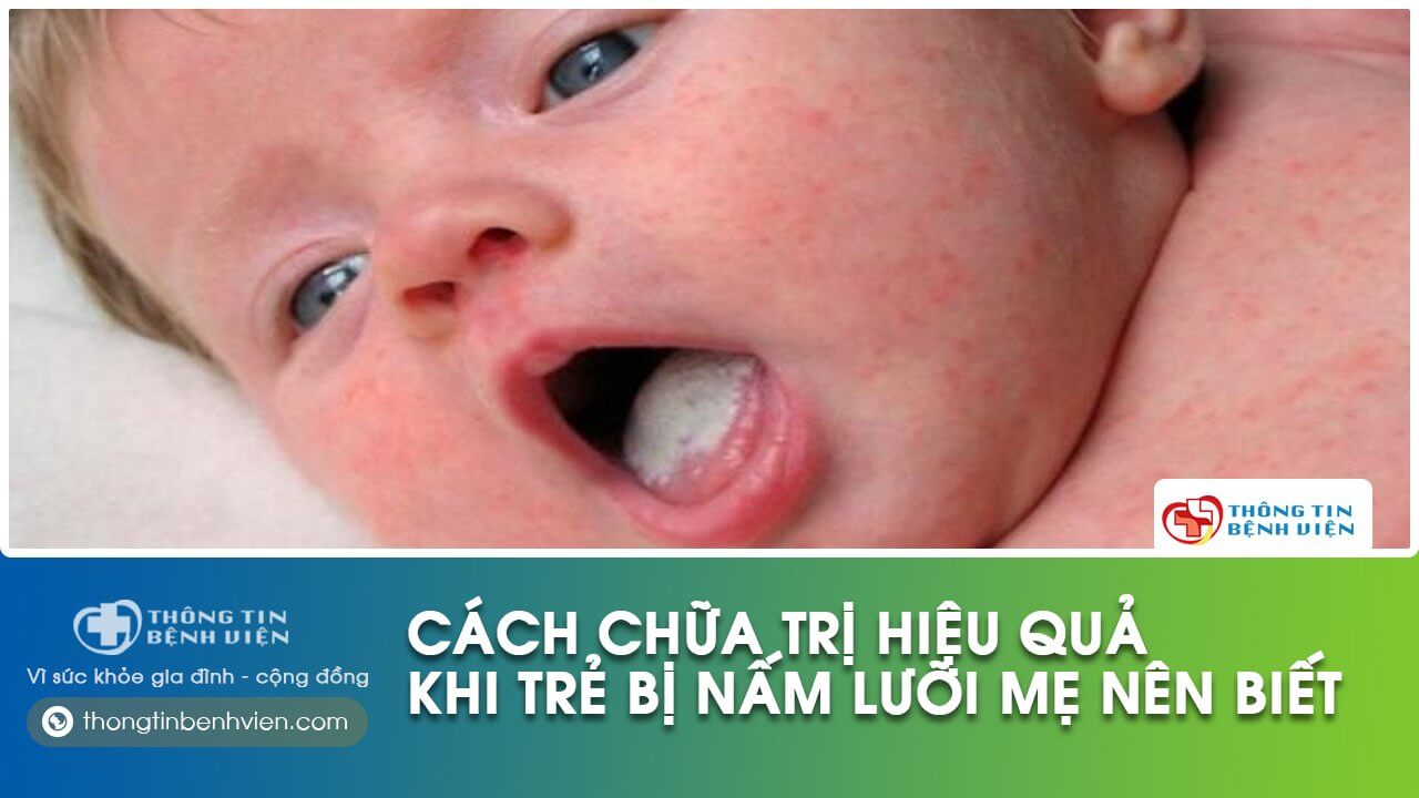 trẻ sơ sinh bị nấm lưỡi