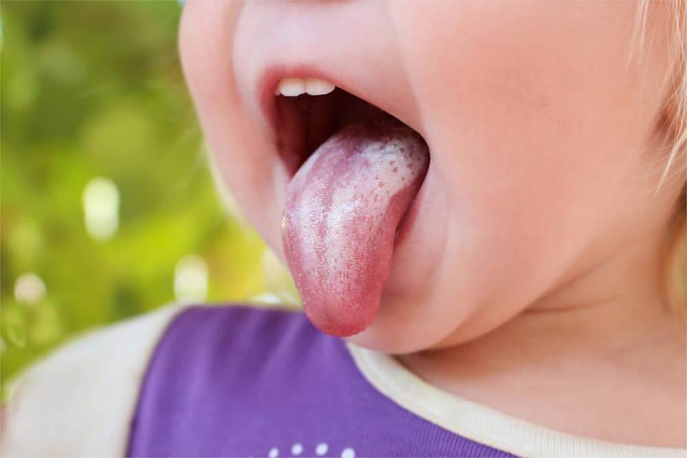 Trẻ bị nấm miệng