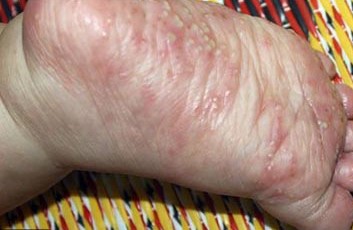 trẻ bị nổi mụn nước ở lòng bàn chân