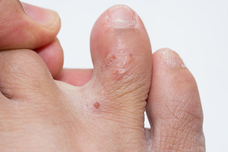 trẻ bị nổi mụn nước ở lòng bàn chân