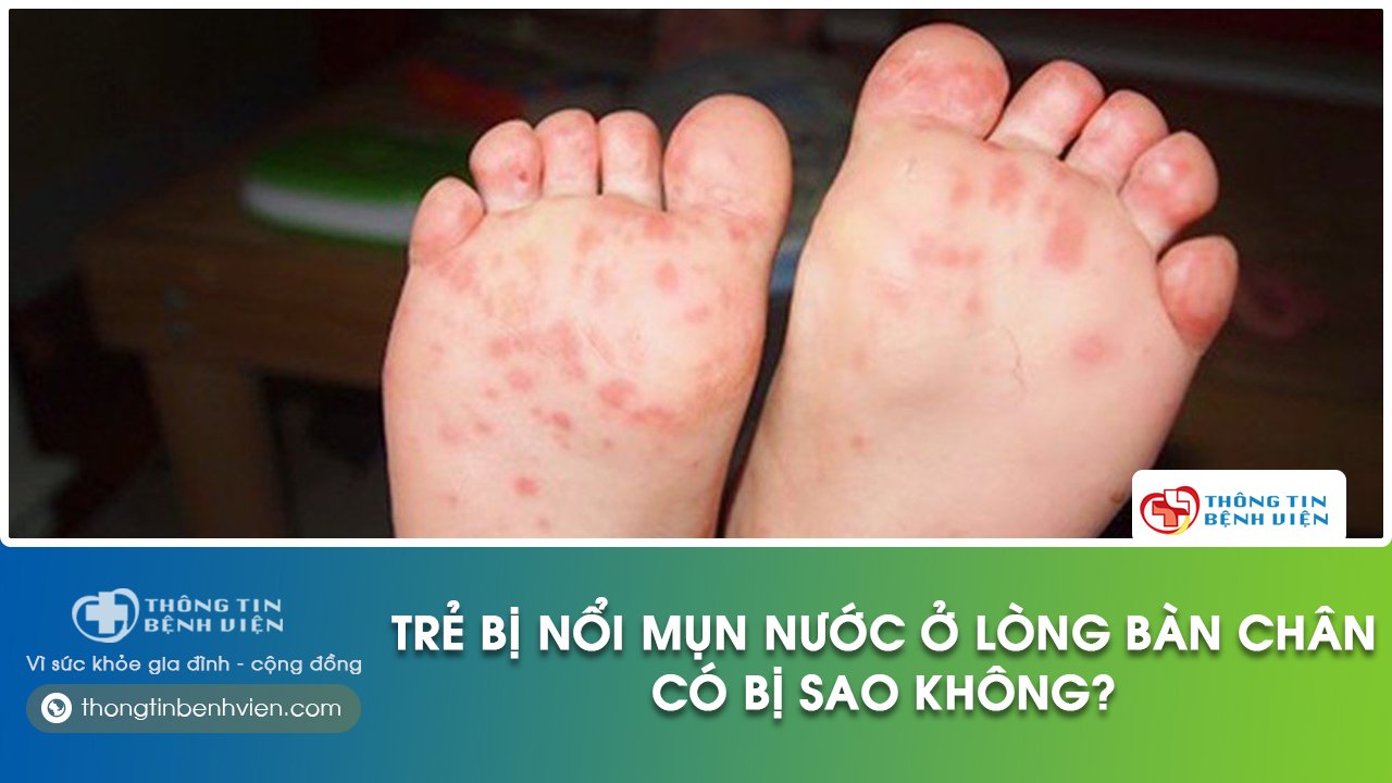 trẻ bị nổi mụn nước ở lòng bàn chân