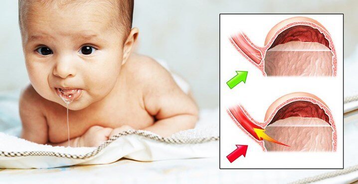 trào ngược dạ dày thực quản