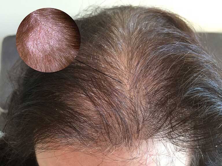Nấm da đầu gây ra rụng tóc ở trẻ