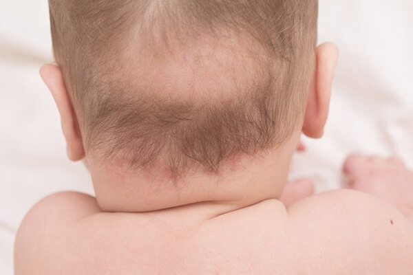 Trẻ bị rụng tóc vành khăn