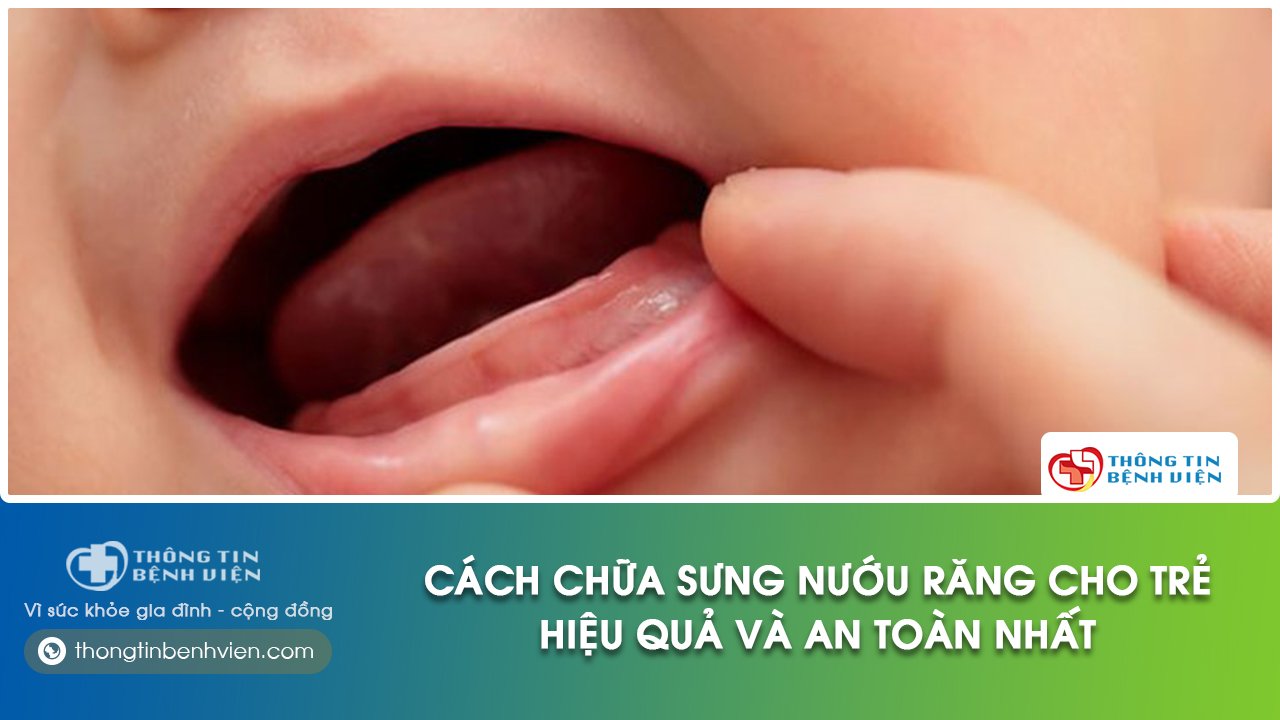 trẻ bị sưng nướu răng