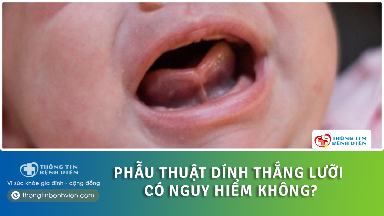 trẻ bị dính thắng lưỡi