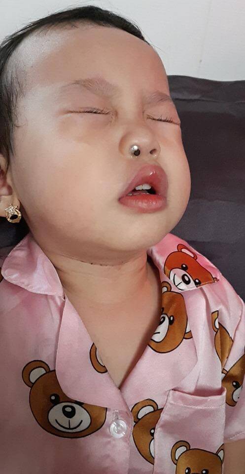 Trẻ bỏ dị vật vào muĩ