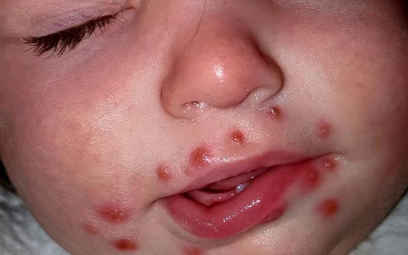 bé bị nổi mụn