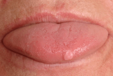 nổi mụn nước trong lưỡi