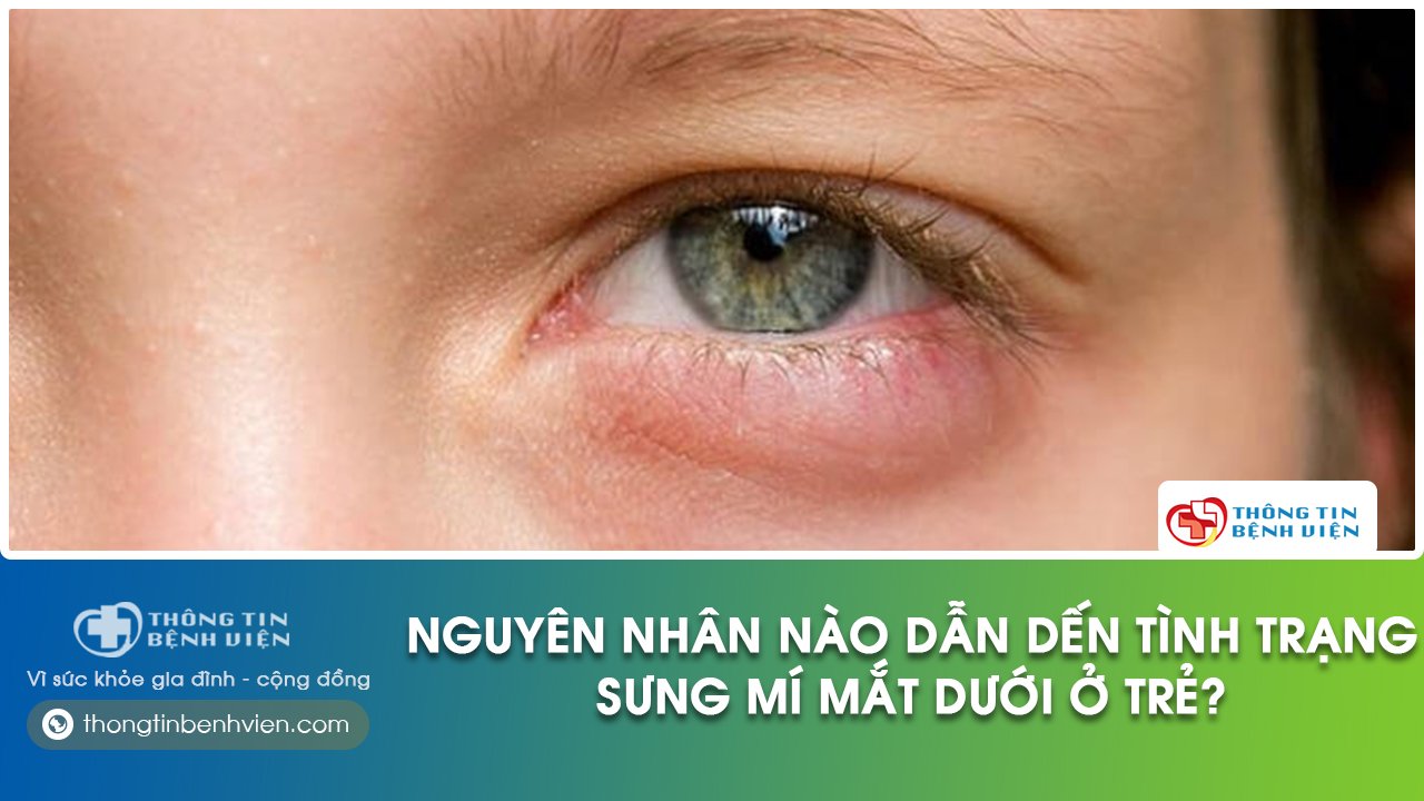 trẻ em bị sưng mí mắt dưới