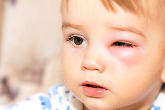 Trẻ em bị sưng mí mắt dưới do nấm hoặc côn trùng đốt