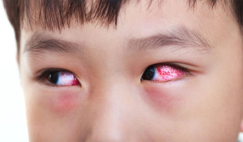 Trẻ em bị sưng mí mắt dưới có thể là do bệnh viêm kết mạc
