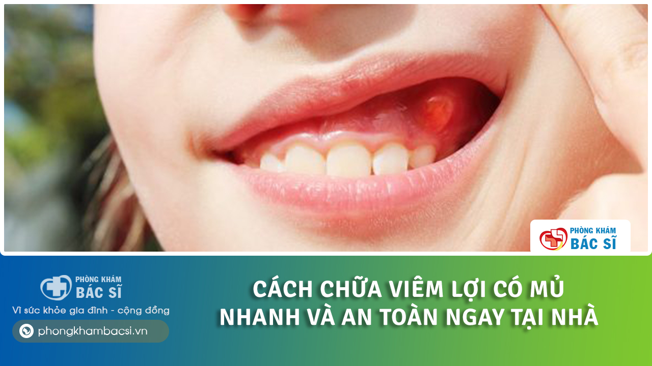 cách chữa viêm lợi có mủ tại nhà