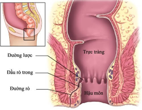 Bệnh rò hậu môn là gì?