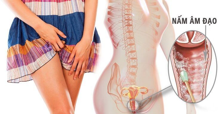 Tác nhân phổ biến nhất gây nhiễm nấm ở vùng kín là nấm Candida albicans