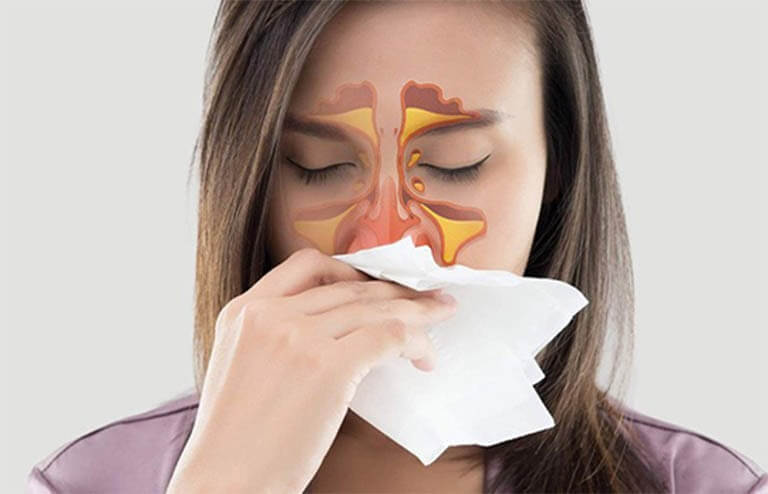 Cơn đau do viêm xoang có thể biểu hiện ở trán, hai bên mũi, hàm trên hoặc giữa hai mắt