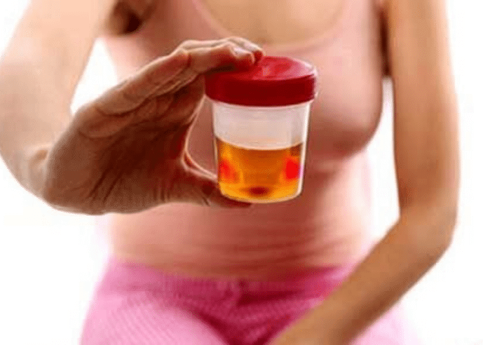 Tiểu buốt ra máu đại thể: Nước tiểu có màu sắc đỏ hoặc hồng rõ rệt