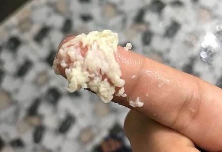 Tình trạng khí hư màu trắng đục như bã đậu