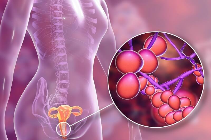 nấm Candida là mầm bệnh chủ yếu gây ra viêm nhiễm vùng kín