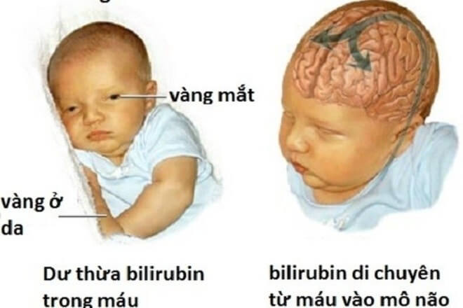 Trẻ bị vàng mắt bệnh lý khi chỉ số bilirubin trong máu cao hơn ngưỡng bình thường