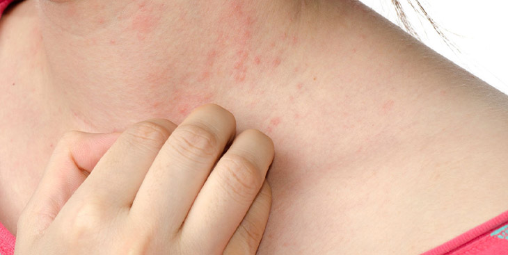 Các triệu chứng sẽ biểu hiện trên da đầu tiên như phát ban, mẩn đỏ, ngứa, sưng phù
