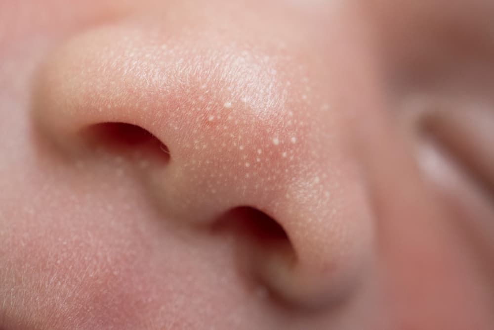 Mụn sữa thường xuất hiện ở mũi, cằm, má hoặc cơ quan sinh dục trẻ sơ sinh
