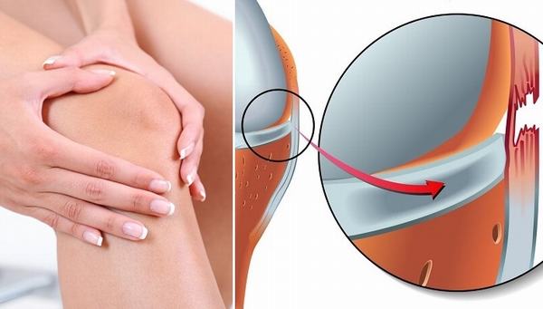 Thế nào là giãn dây chằng đầu gối?