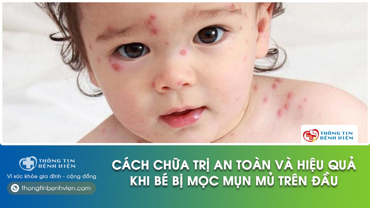 trẻ bị nổi mụn mủ trên đầu