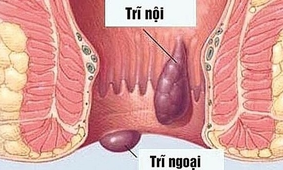 Bệnh trĩ nội là tình trạng tĩnh mạch vùng hậu môn trực tràng bị giãn và phình to ra