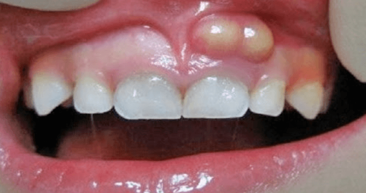 Viêm lợi thường ở một vùng nhỏ hoặc lan ra viêm xung quanh răng