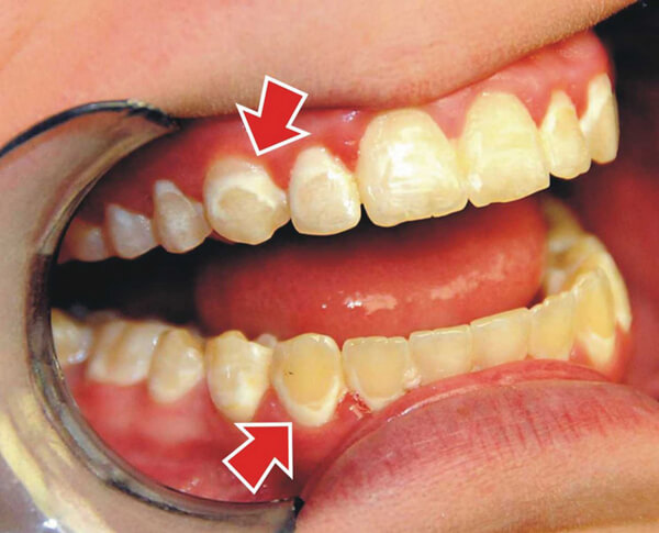 Bệnh nha chu là một bệnh viêm nhiễm vùng nướu (vùng lợi)