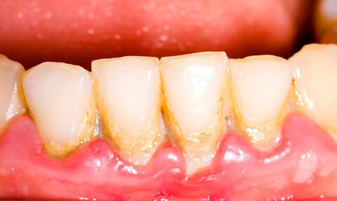 vệ sinh răng không sạch sẽ
