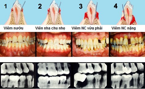 Các giai đoạn của bệnh viêm nha chu