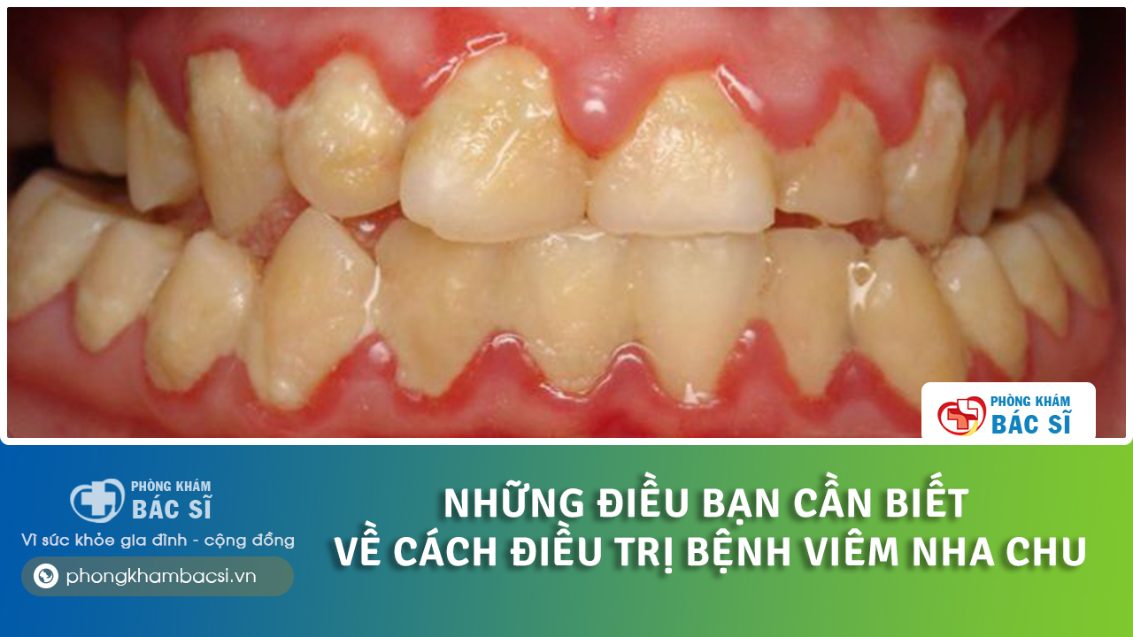 cách chữa viêm nha chu răng tại nhà