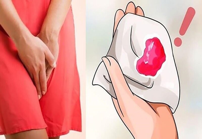 Chảy máu âm đạo mà phụ nữ không trong chu kì kinh nguyệt