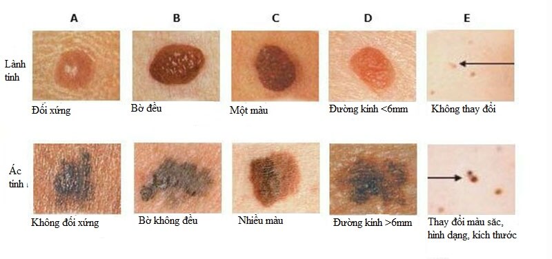 Dấu hiệu nhận biết ung thư da