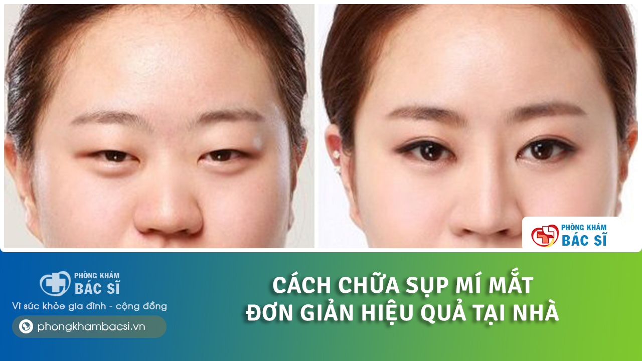 cách chữa sụp mí mắt đơn giản tại nhà
