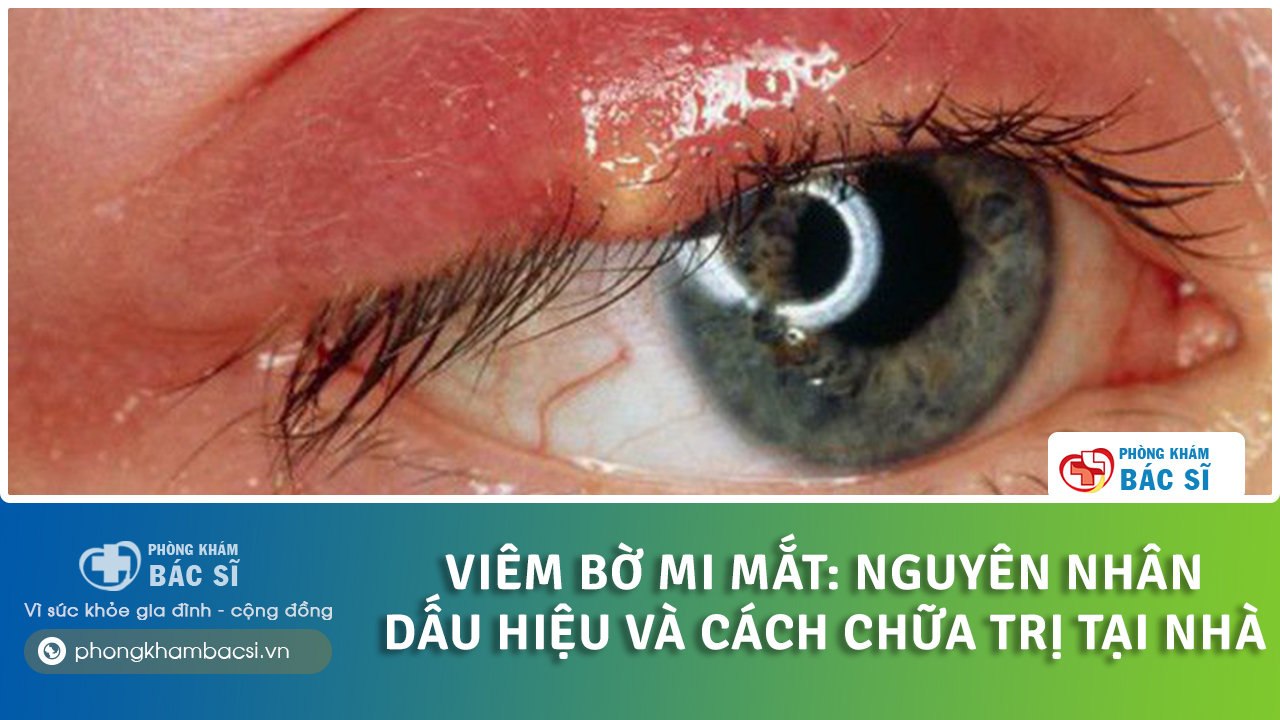 cách chữa viêm bờ mi mắt tại nhà