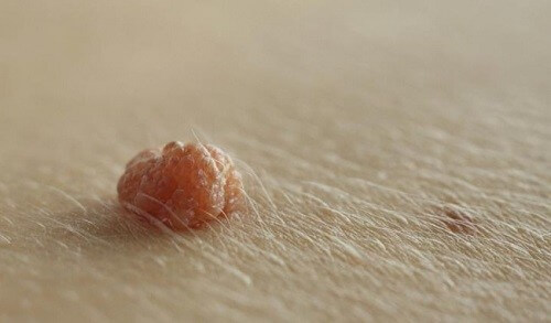 Cách phòng tránh mụn thịt ở vùng kín