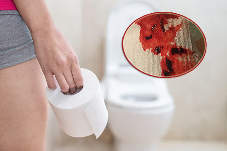 Người bị chảy máu hậu môn có dấu hiệu xuất hiện máu đi đi đại tiện