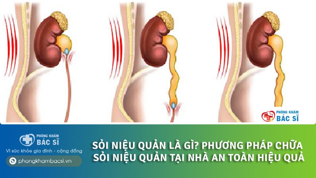 Chữa sỏi niệu quản tại nhà